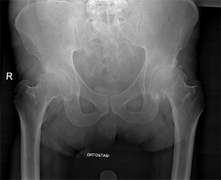 Coxartrosi bilaterale - Intervento di protesi di anca bilaterale simultanea con tecnica mini invasiva