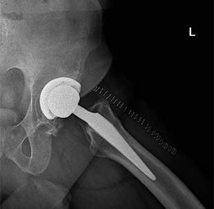 Coxartrosi bilaterale - Intervento di protesi di anca bilaterale simultanea con tecnica mini invasiva