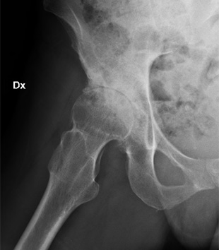 Chirurgia ortopedica protesi ginocchio e anca - Bergamo..