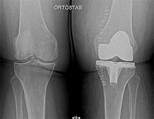 Gonartrosi bilaterale - Intervento di pro protesi totale mini invasiva di ginocchio a conservazione del legamento crociato posteriore