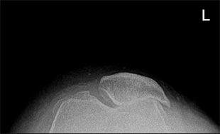 Gonartrosi bilaterale - Intervento di pro protesi totale mini invasiva di ginocchio a conservazione del legamento crociato posteriore