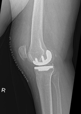 Gonartrosi mediale bilaterale: inserimento protesi monocompartimentale mediale bilaterale di ginocchio con tecnica mini invasiva