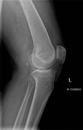 Inserimento protesi monocompartimentale mediale di ginocchio con tecnica mini invasiva.