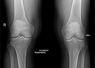 Inserimento protesi monocompartimentale mediale di ginocchio con tecnica mini invasiva.