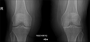 Intervento di protesi monocompartimentale mediale + protesi femoro rotulea con tecnica mini invasiva a sinistra
