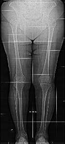 Chirurgia ortopedica protesi ginocchio e anca - Bergamo..