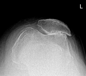 Intervento di protesi monocompartimentale mediale + protesi femoro rotulea con tecnica mini invasiva a sinistra