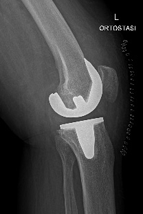 Inserimento protesi totale mini invasiva del ginocchio