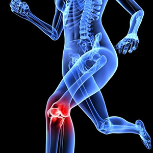 Gonartrosi: artrosi al ginocchio - Chirurgia ortopedica..
