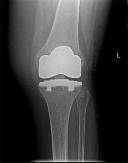 protesi ginocchio innovativa e miniinvasiva