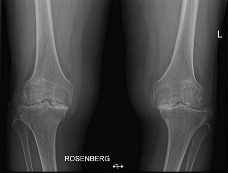 Protesi totale ginocchio - radiografia pre intervento