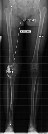 Intervento chirurgico con protesi monocompartimentale laterale di ginocchio