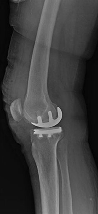 Intervento chirurgico con protesi monocompartimentale laterale di ginocchio
