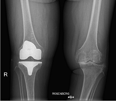 Protesi totale ginocchio - radiografia dopo l'intervento