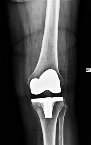 Protesi totale del ginocchio