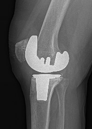 Revisione protesi totale ginocchio