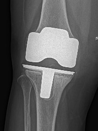 Revisione protesi ginocchio