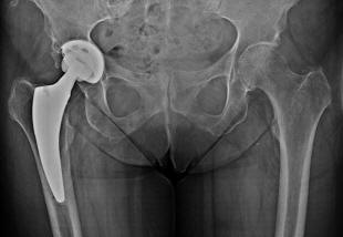 Impianto di una protesi di anca destra con tecnica mini invasiva
