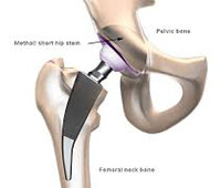 Valutazione clinica per l'inserimento di una protesi all'anca
