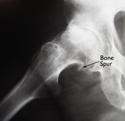 Radiografia anca affetta da artrosi