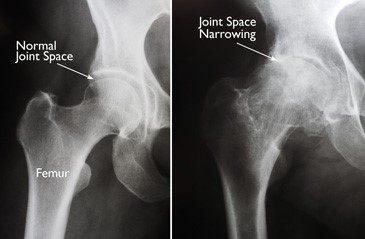 Radiografia anca normale