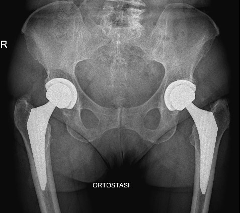 Impianto bilaterale con protesi anca mini invasiva: radiografia