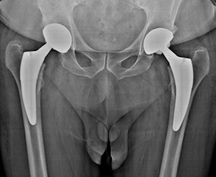 Radiografia pre e post operatoria di una protesi bilaterale mini invasiva di anca eseguita in contemporanea