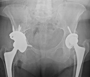 Revisione protesi dell'anca