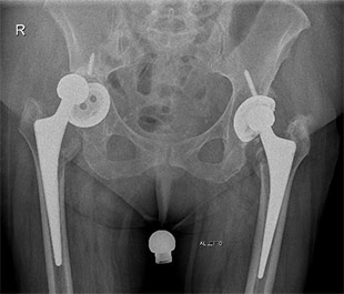 Revisione protesi dell'anca